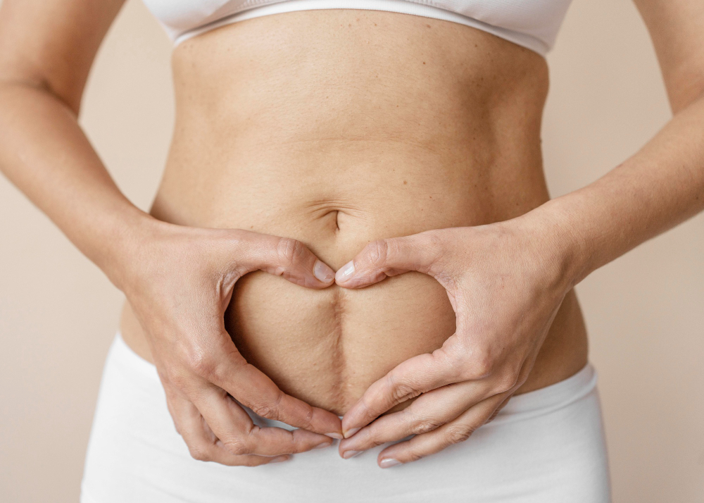 A woman proudly shows out her tummy to highlight her confidence and stretch mark prevention.